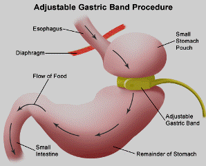 laparoscopic gastric banding surgery